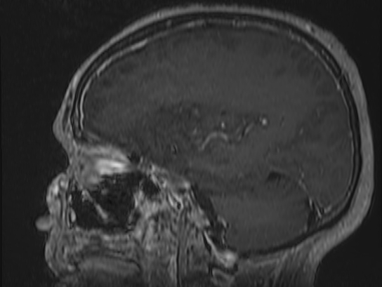 Atypical meningioma (Radiopaedia 62985-71406 Sagittal T1 C+ 58).jpg