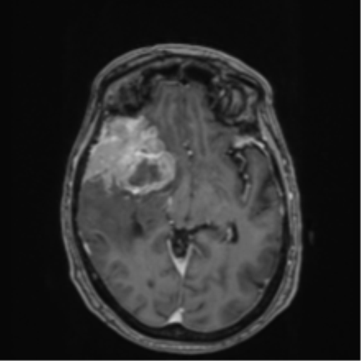 Atypical meningioma (WHO Grade II) (Radiopaedia 54742-60979 Axial T1 C+ 28).png