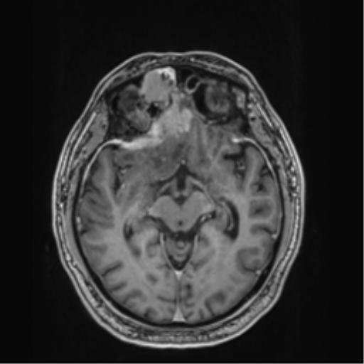 File:Atypical meningioma (WHO grade II) with brain invasion (Radiopaedia 57767-64729 Axial T1 C+ 20).png