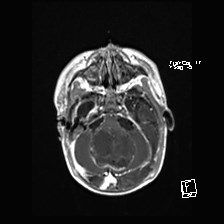 File:Atypical teratoid rhabdoid tumor (prenatal US and neonatal MRI) (Radiopaedia 59091-66388 Axial T1 C+ 17).jpg