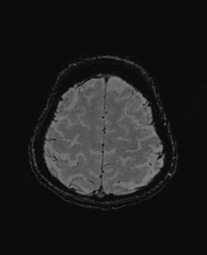 Autoimmune limbic encephalitis (Radiopaedia 30363-31005 SWI 67).jpg