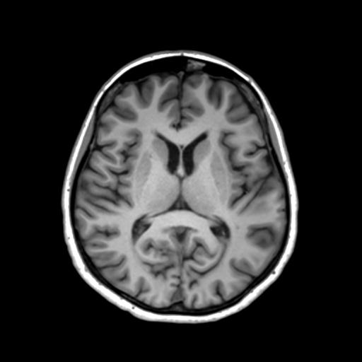 Autoimmune limbic encephalitis (Radiopaedia 30363-31005 T1 Axial 3mm 28).jpg
