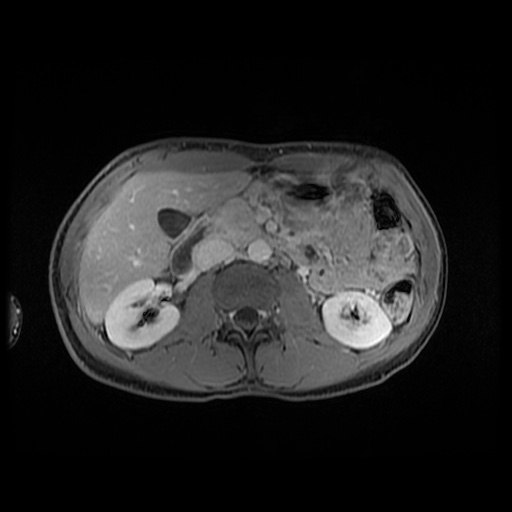 File:Autoimmune pancreatitis (Radiopaedia 69751-79729 N 76).jpg