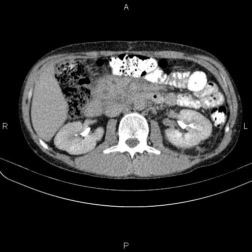 File:Autoimmune pancreatitis (Radiopaedia 84925-100431 Axial C+ delayed 32).jpg