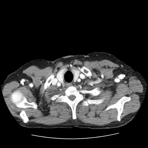 Autosomal dominant polycystic kidney disease (Radiopaedia 27851-28094 B 4).jpg
