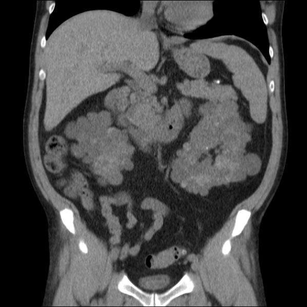 File:Autosomal dominant polycystic kidney disease (Radiopaedia 36539-38101 C 32).jpg