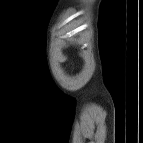 Autosomal dominant polycystic kidney disease (Radiopaedia 36539-38101 D 7).jpg