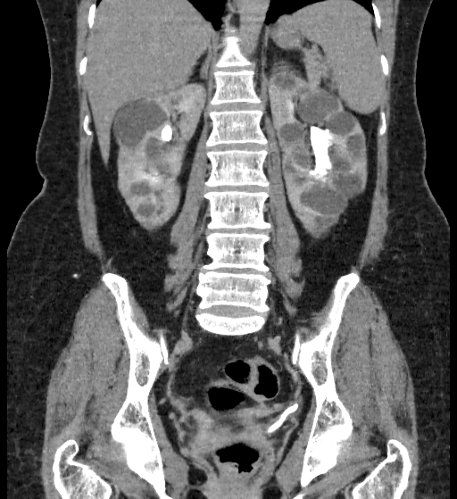 File:Autosomal dominant polycystic kidney disease (Radiopaedia 38189-40194 Coronal C+ delayed 65).jpg