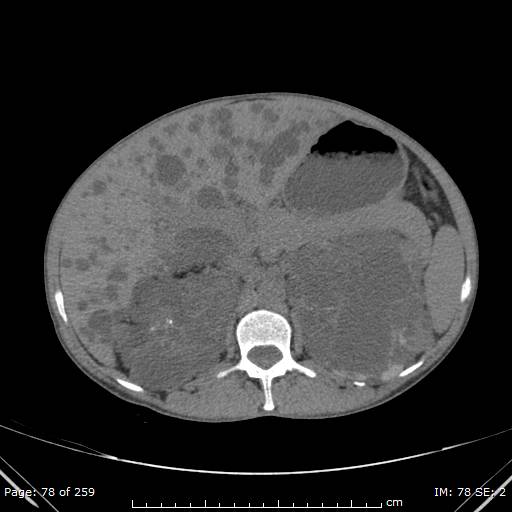 File:Autosomal dominant polycystic kidney disease (Radiopaedia 44122-47684 Axial 39).jpg