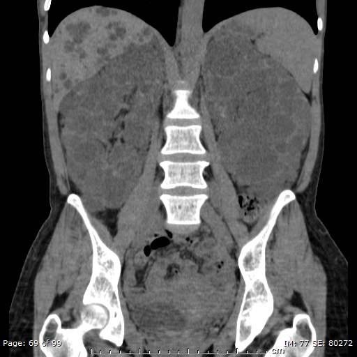 File:Autosomal dominant polycystic kidney disease (Radiopaedia 44122-47684 Coronal 12).jpg