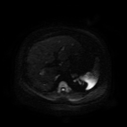 Autosomal dominant polycystic kidney disease (Radiopaedia 50259-55611 Axial DWI 85).jpg