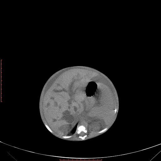 Autosomal recessive polycystic kidney disease associated with Caroli disease (Radiopaedia 61932-69984 Axial non-contrast 143).jpg