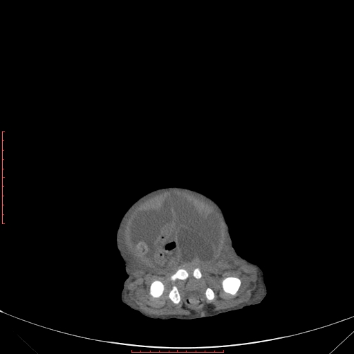 Autosomal recessive polycystic kidney disease associated with Caroli disease (Radiopaedia 61932-69984 Axial non-contrast 345).jpg