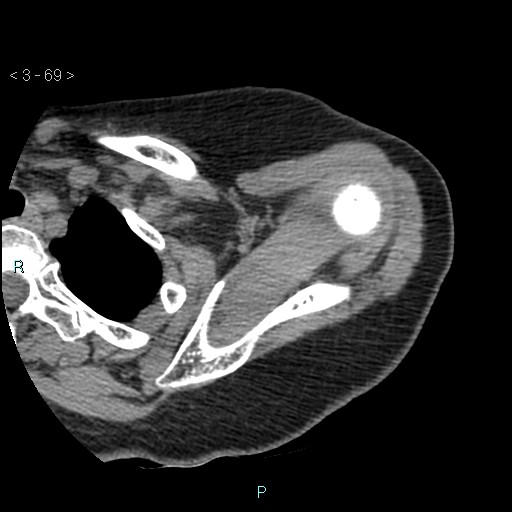 File:Avascular necrosis of the shoulder - Cruess stage I (Radiopaedia 77674-89887 Axial soft tissues 23).jpg