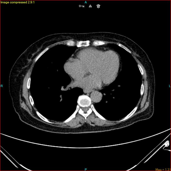 Azygos vein aneurysm (Radiopaedia 77824-90130 A 38).jpg