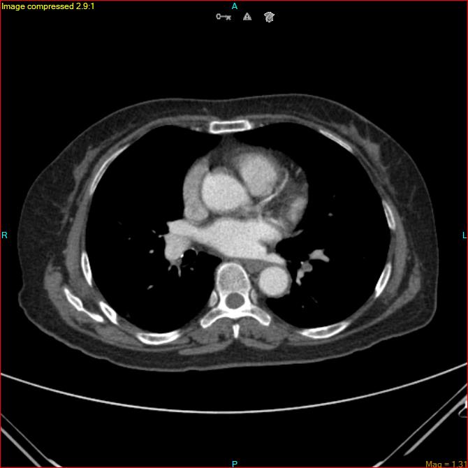 Azygos vein aneurysm (Radiopaedia 77824-90130 B 32).jpg