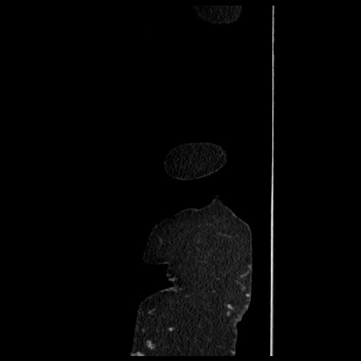 B-cell lymphoma of the mesentery (Radiopaedia 65711-74827 C 14).jpg