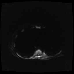 B cell lymphoma (Radiopaedia 56281-62954 Axial DWI 1).jpg