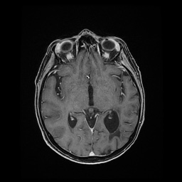 Balo concentric sclerosis (Radiopaedia 53875-59982 Axial LAVA C+ 126).jpg