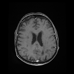 Balo concentric sclerosis (Radiopaedia 53875-59982 Axial LAVA C+ 170).jpg
