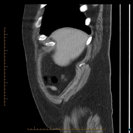 File:Bariatric balloon causing gastric outlet obstruction (Radiopaedia 54449-60672 C 73).jpg