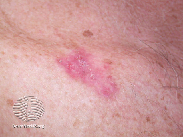 File:Basal cell carcinoma affecting the trunk (DermNet NZ lesions-bcc-trunk-1097).jpg