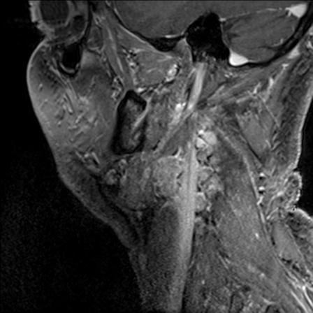 Base of tongue squamous cell carcinoma (Radiopaedia 31174-31884 F 139).jpg