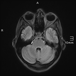 File:Basilar artery perforator aneurysm (Radiopaedia 82455-99523 Axial FLAIR 7).jpg