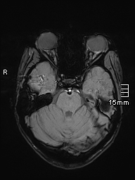 Basilar artery perforator aneurysm (Radiopaedia 82455-99523 Axial SWI 20).jpg