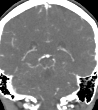 Basilar tip aneurysm with coiling (Radiopaedia 53912-60086 B 103).jpg
