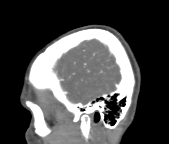 Basilar tip aneurysm with coiling (Radiopaedia 53912-60086 C 10).jpg