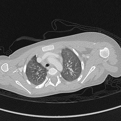 Beckwith-Wiedeman syndrome with bilateral Wilms tumors (Radiopaedia 60850-68629 Axial lung window 20).jpg