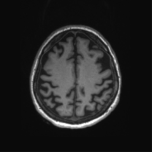 Behavioral variant frontotemporal dementia and late onset schizophrenia (Radiopaedia 52197-58083 Axial T1 20).png