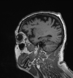 Behavioral variant frontotemporal dementia and late onset schizophrenia (Radiopaedia 52197-58083 Sagittal T1 79).png