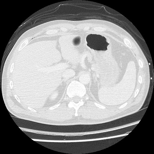 Benign post-traumatic pseudopneumoperitoneum (Radiopaedia 71199-81495 Axial lung window 68).jpg
