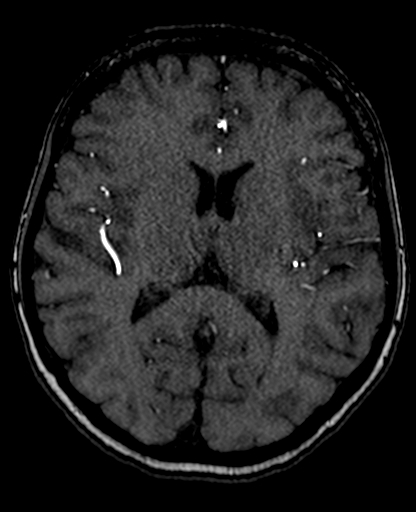 Berry aneurysm of the terminal internal carotid artery (Radiopaedia 88286-104918 Axial TOF 137).jpg