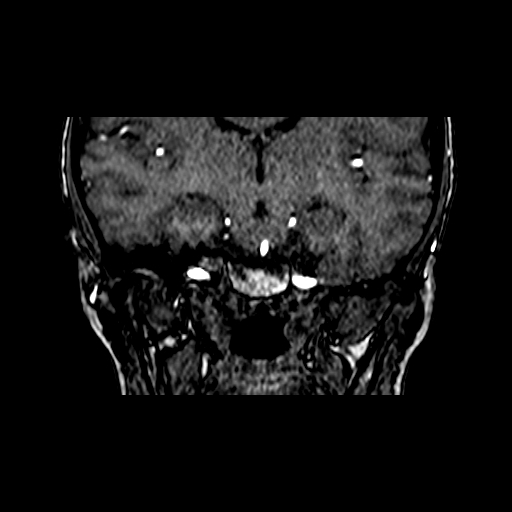 File:Berry aneurysm of the terminal internal carotid artery (Radiopaedia 88286-104918 Coronal TOF 51).jpg