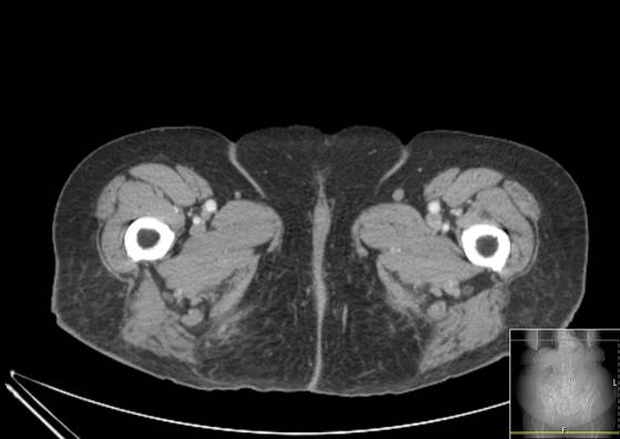 Bicameral celiacomesenteric aneurysm (Radiopaedia 55766-62327 A 85).jpg