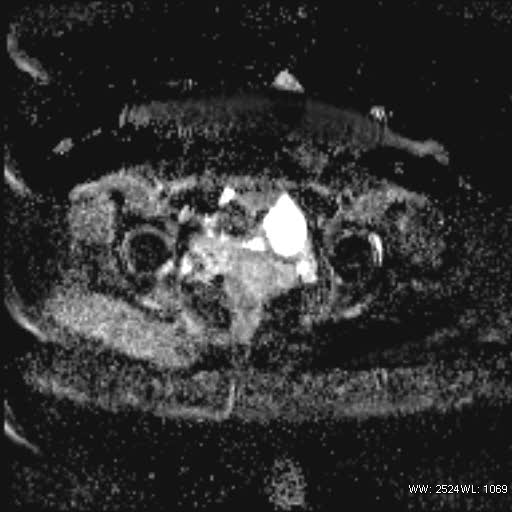 File:Bicornuate uterus- on MRI (Radiopaedia 49206-54297 Axial ADC 17).jpg