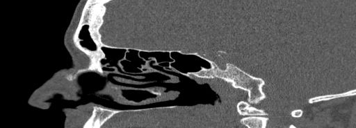 Bilateral Ectopic Infraorbital Nerves (Radiopaedia 49006-54084 Sagittal bone window 29).jpg