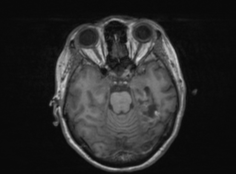 Bilateral PCA territory infarction - different ages (Radiopaedia 46200-51784 Axial T1 276).jpg