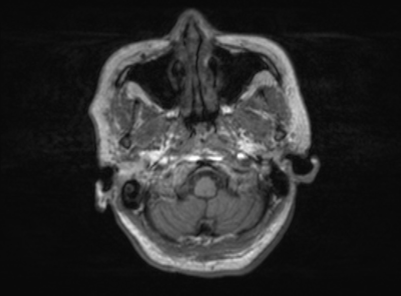Bilateral PCA territory infarction - different ages (Radiopaedia 46200-51784 Axial T1 340).jpg