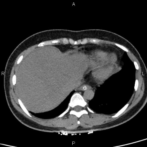 Bilateral adrenal gland hyperenhancement in pancreatitis (Radiopaedia 86642-102753 Axial non-contrast 10).jpg