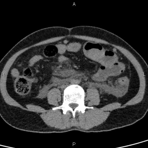 Bilateral adrenal gland hyperenhancement in pancreatitis (Radiopaedia 86642-102753 Axial non-contrast 69).jpg
