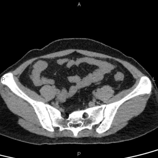 File:Bilateral adrenal gland hyperenhancement in pancreatitis (Radiopaedia 86642-102753 Axial non-contrast 87).jpg