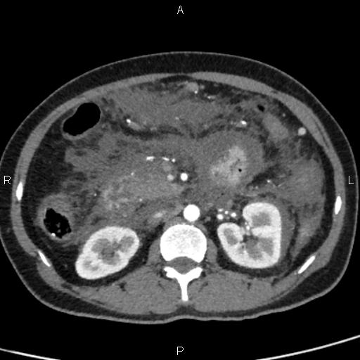 Bilateral adrenal gland hyperenhancement in pancreatitis (Radiopaedia 86642-102753 B 60).jpg