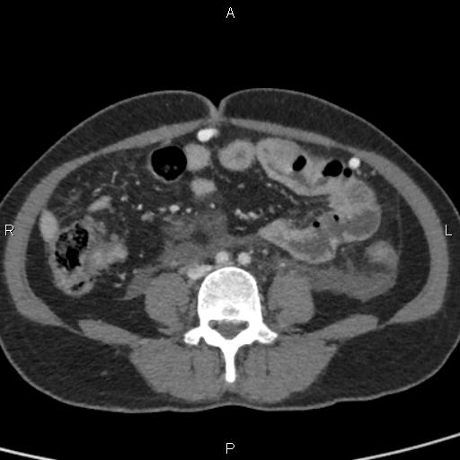 Bilateral adrenal gland hyperenhancement in pancreatitis (Radiopaedia 86642-102753 E 71).jpg