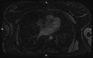 Bilateral adrenal myelolipoma (Radiopaedia 63058-71537 Axial T1 C+ fat sat 1).jpg