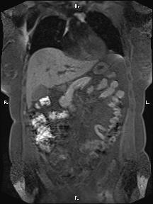 Bilateral adrenal myelolipoma (Radiopaedia 63058-71537 Coronal T1 fat sat 72).jpg