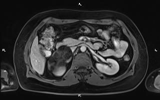 Bilateral adrenal myelolipoma (Radiopaedia 63058-71537 G 45).jpg